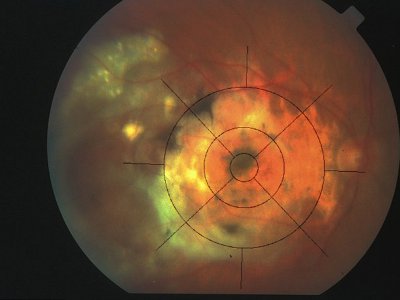 Fond de l'oeil montrant une dégénérescence maculaire liée à l'âge©Inserm