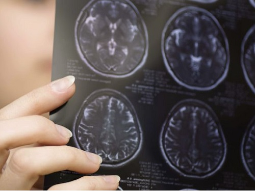 Maladie de Charcot un médecin regardant une radio (illustration)