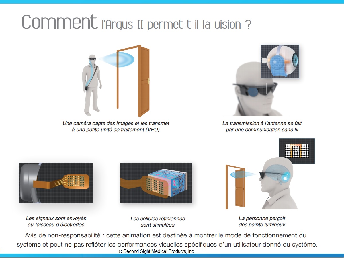 Comment l Argus II permet-t_il la vision image extraite de la brochure du Frabricant