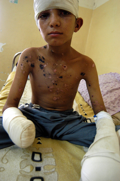 Un enfant ampute des bras et victime de mines