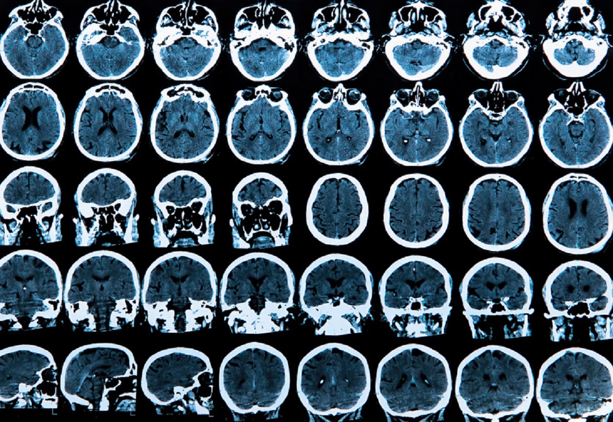 Exemple d analyse de maladie neurodegenerative du cerveau.jpg