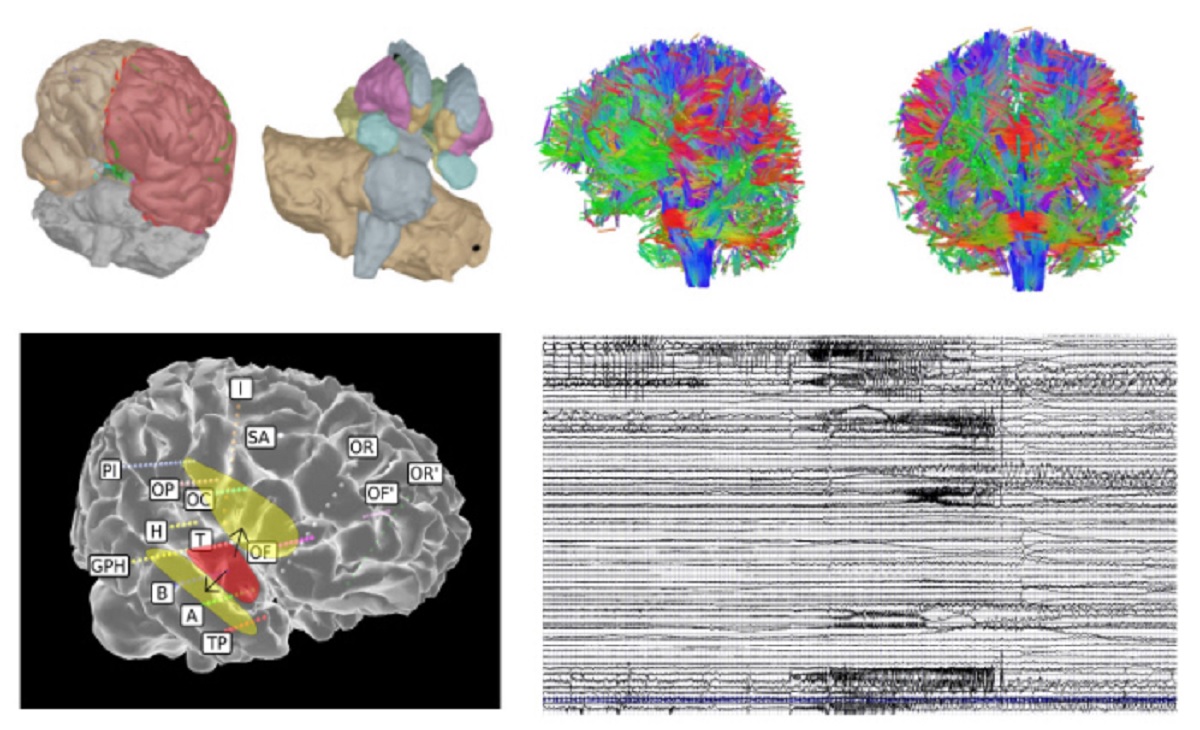 Le patient épileptique virtuel 6d22e