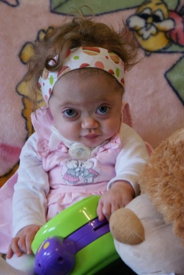 Une petite fille fran&ccedil;aise atteinte du syndrome Marshall Smith Le-syndrome Marshall-Smith, le combat d'une trentaine d'enfants au monde