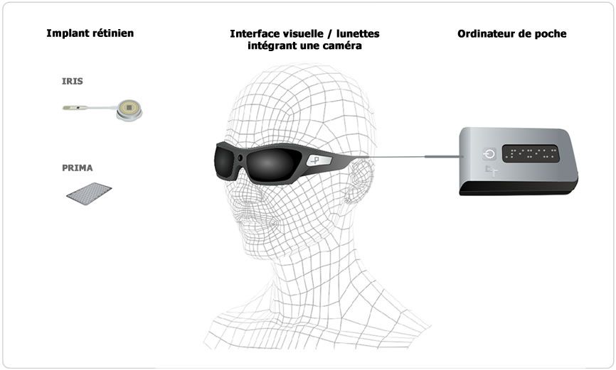 Implant pixium-vision