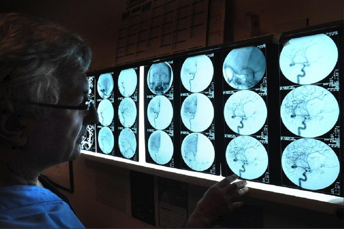 Ce que vous devriez savoir sur lAVC leclairage dun neurologue du CHU de Limoges