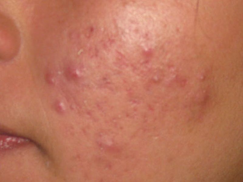 Acne du visage d un homme