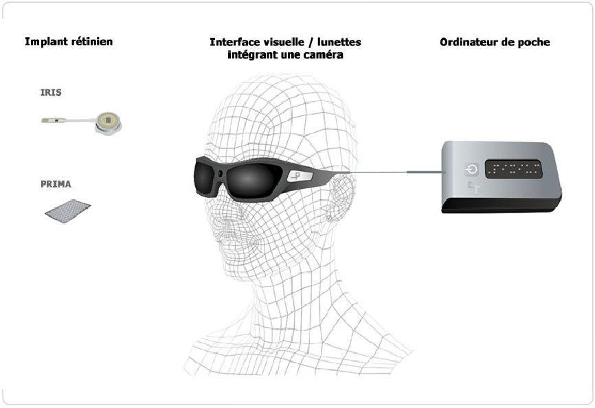 Technologie Pixium Vision