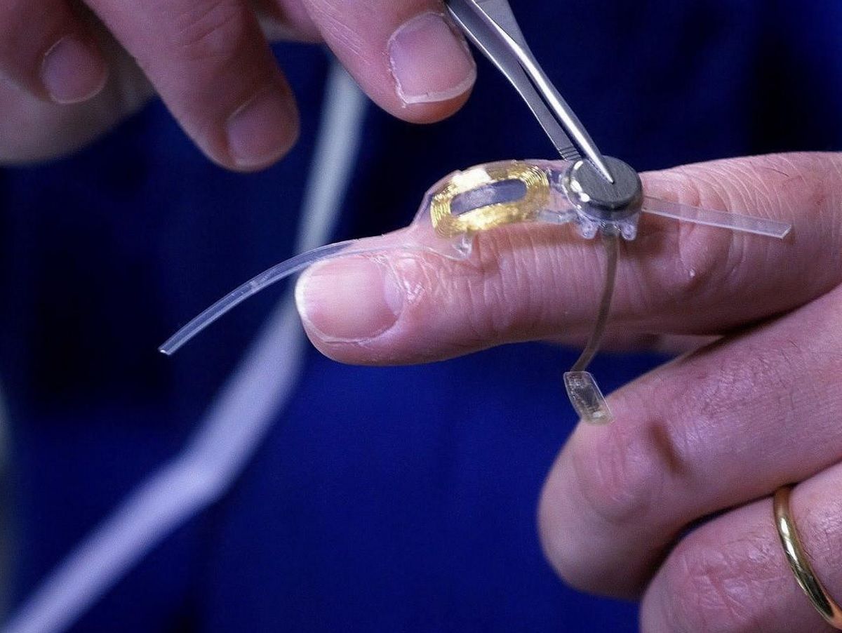 Argus II implant oculaire stimulant artificiellement la retine deficiente