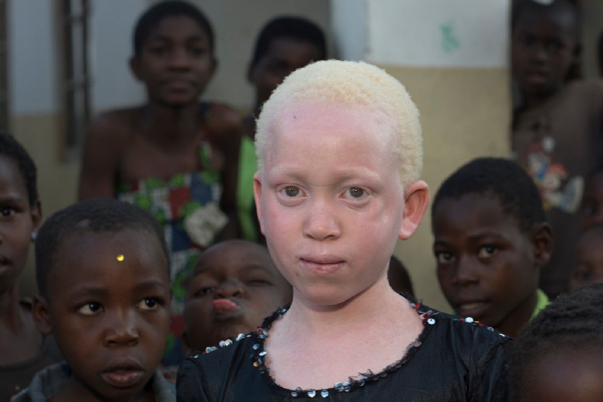 Annie Alfred 10 ans aujourd hui menace de mort au Malawi a cause de superstition et de sa maladie