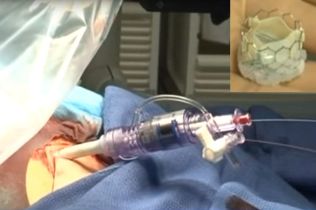 Implantation d une valve aortique sans chirurgie ouverte regard sur une technique en pleine expansion
