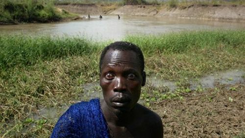 L'onchocercose ou  la cécité des rivières prive de vue un demi-million d'Africains selon l'OMS© OMS