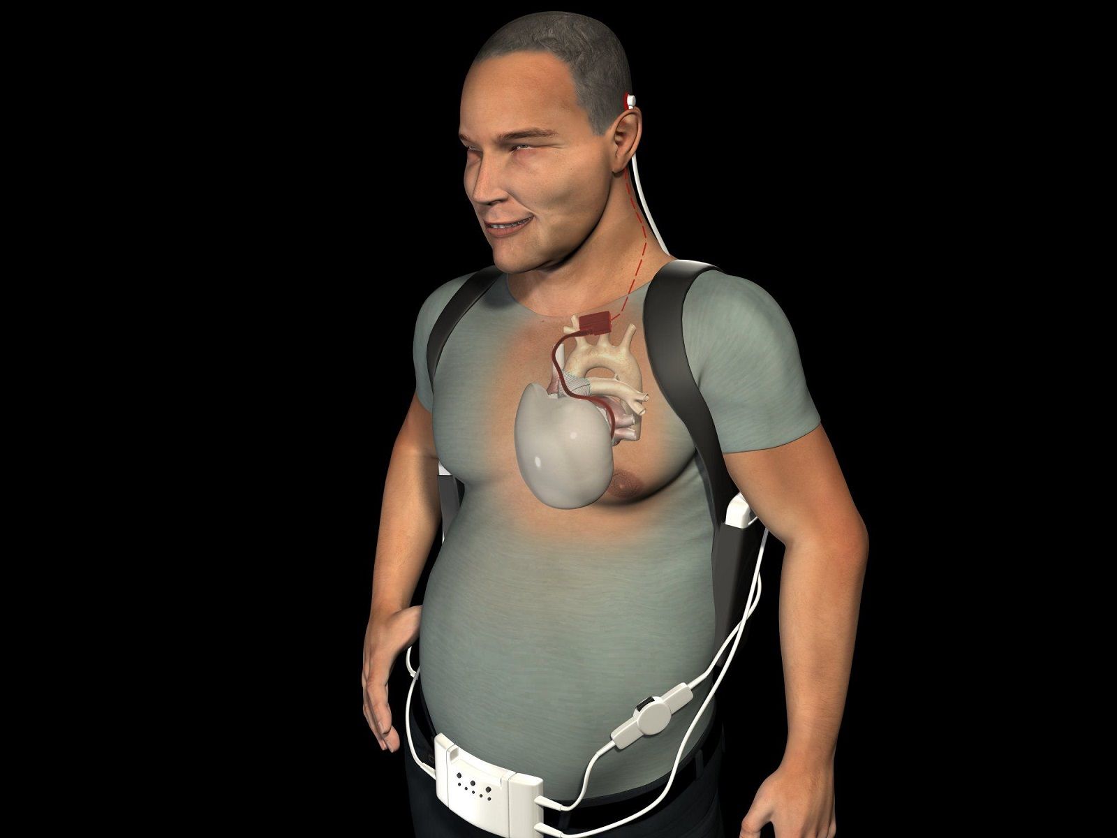 Coeur Artificiel Carmat